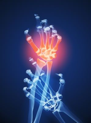 Arthritis X-ray Hand